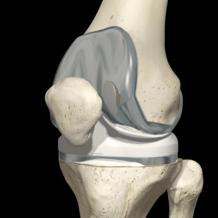 Ολική αρθροπλαστική γόνατος img